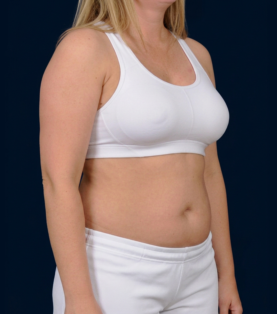 Patient’s midsection before VASER Hi-Def Liposuction, front three-quarter view
