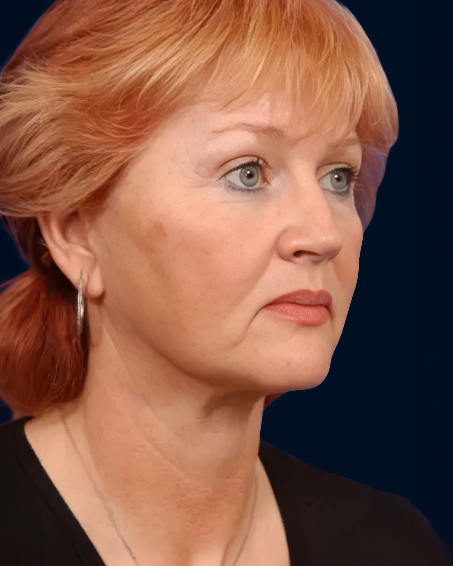The same patient’s face after facelift surgery, showing a more defined jawline and smoother neck