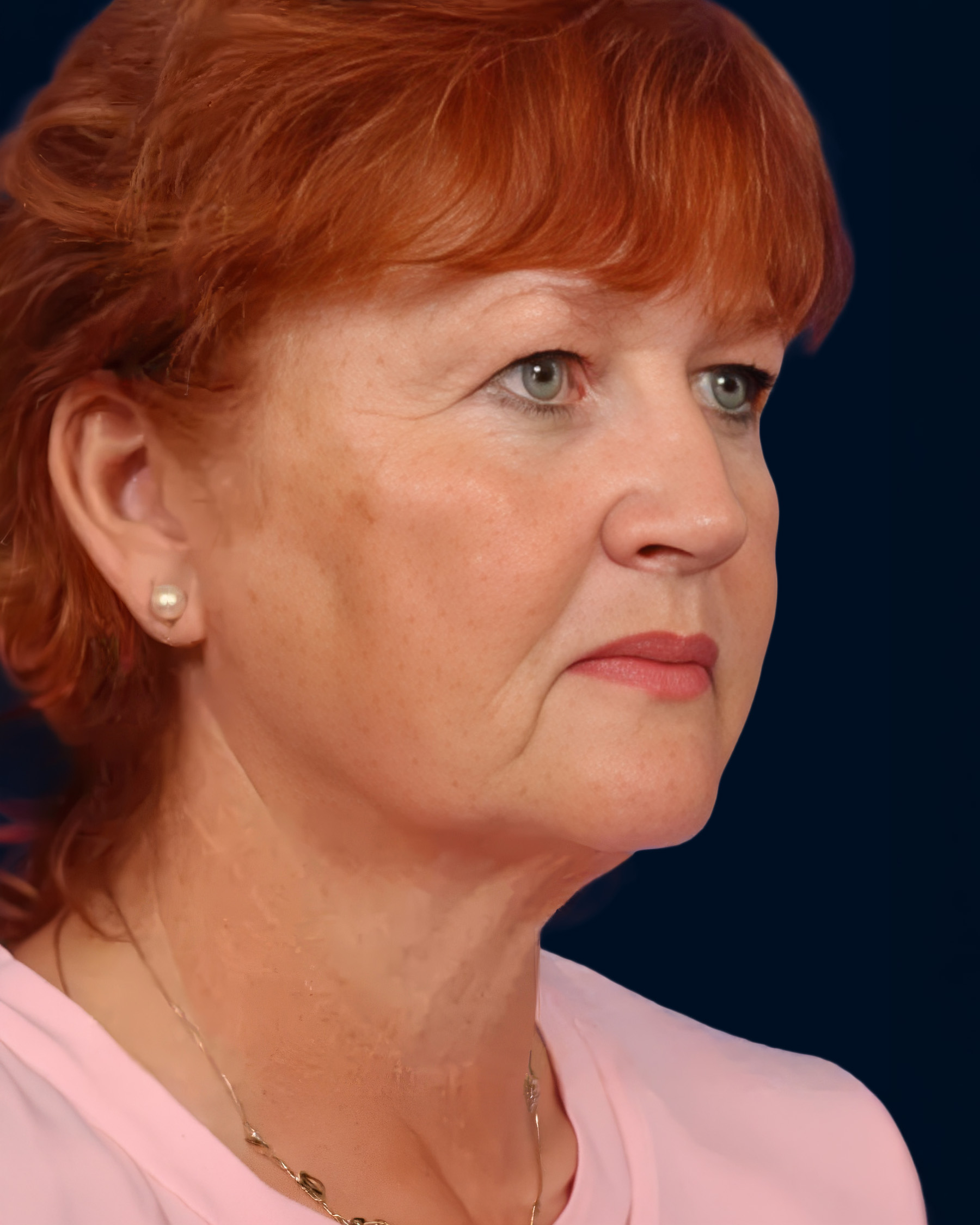 Patient’s face before facelift surgery, three-quarter view showing jowl and neck laxity