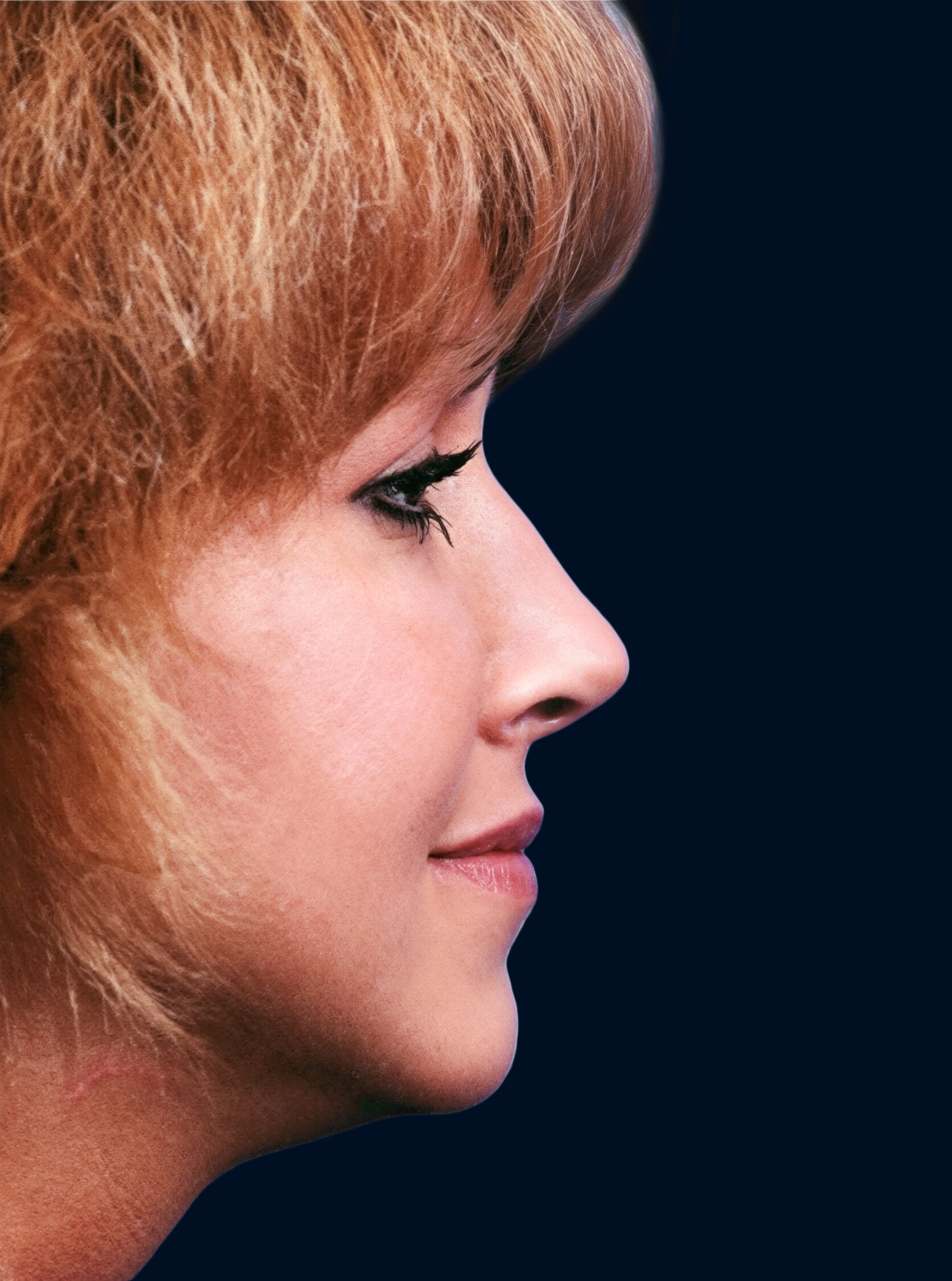 The same patient’s nose in profile after rhinoplasty, showing a smoother bridge and a more refined tip