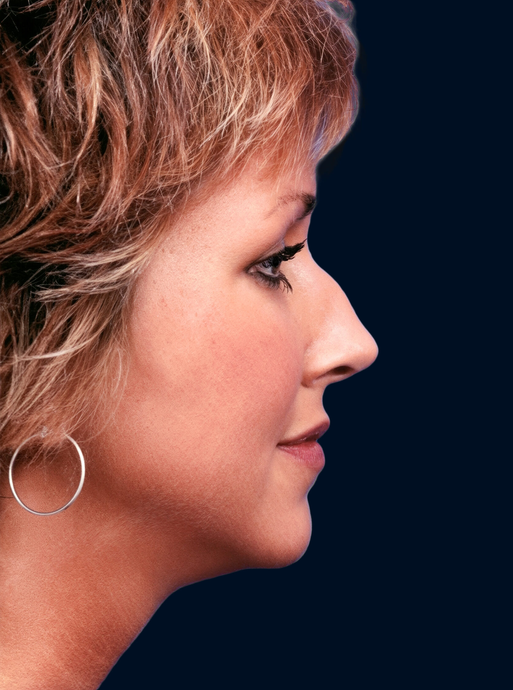 Patient’s nose in profile before rhinoplasty, showing a dorsal hump