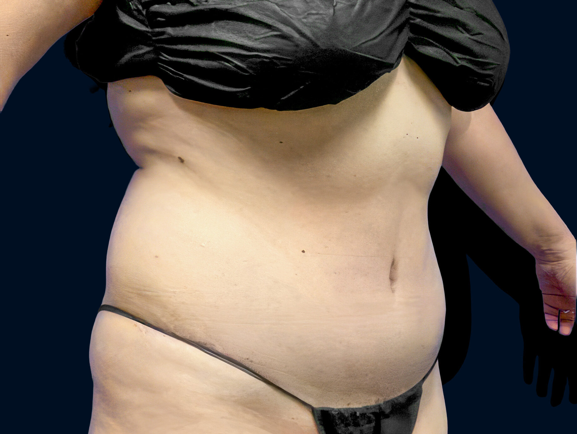 The same patient’s abdomen after tummy tuck surgery, showing a flatter, smoother contour