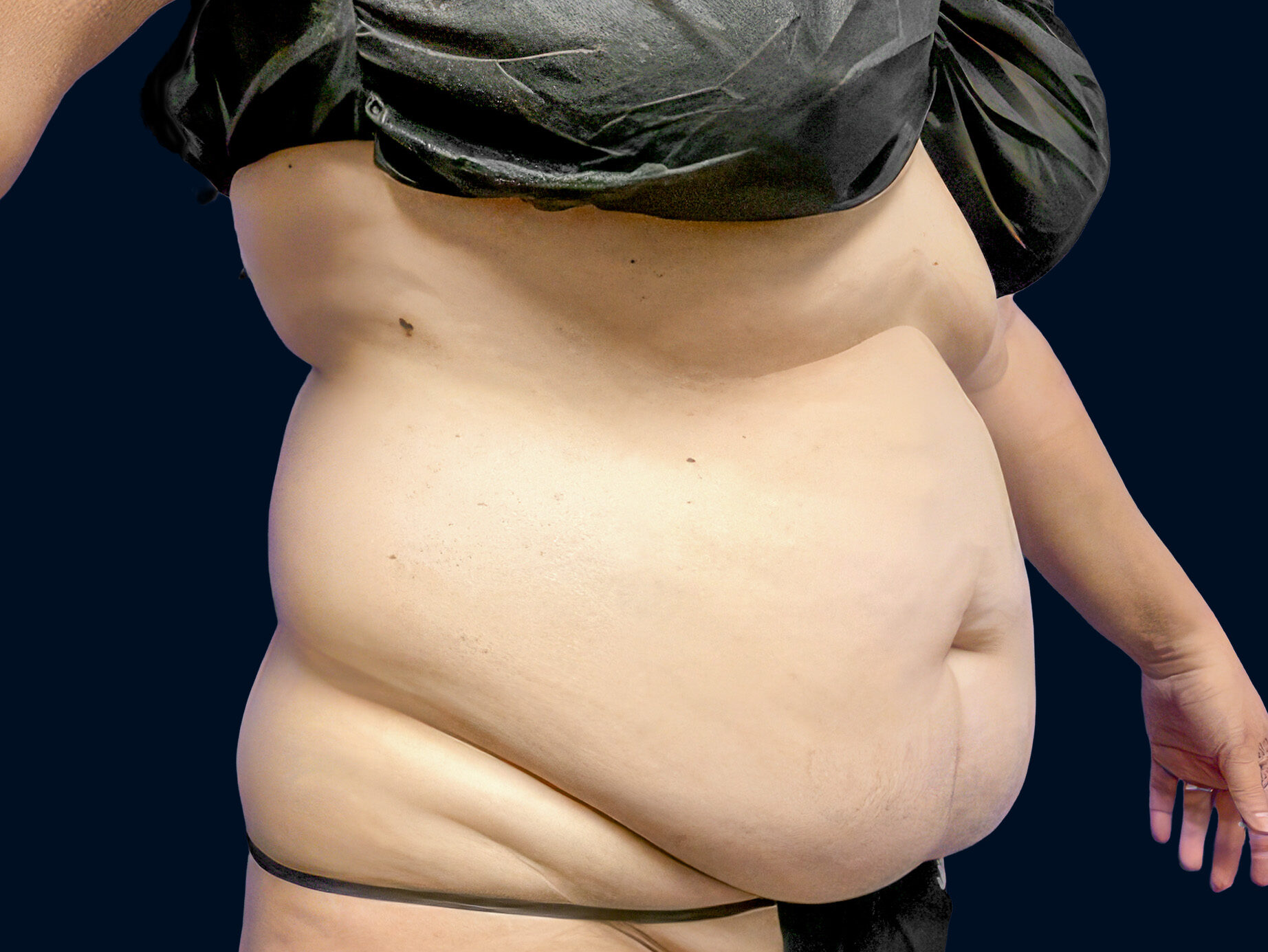 Patient’s abdomen before tummy tuck surgery, side view showing loose skin and a protruding contour