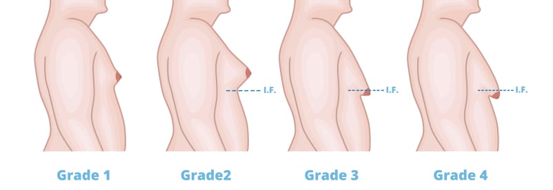 degrees of gynecomastia