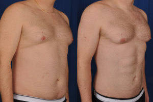 gynecomastia procedure