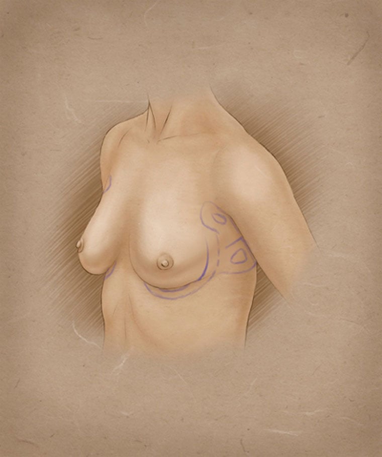BreastEnhancementSlides.002-web