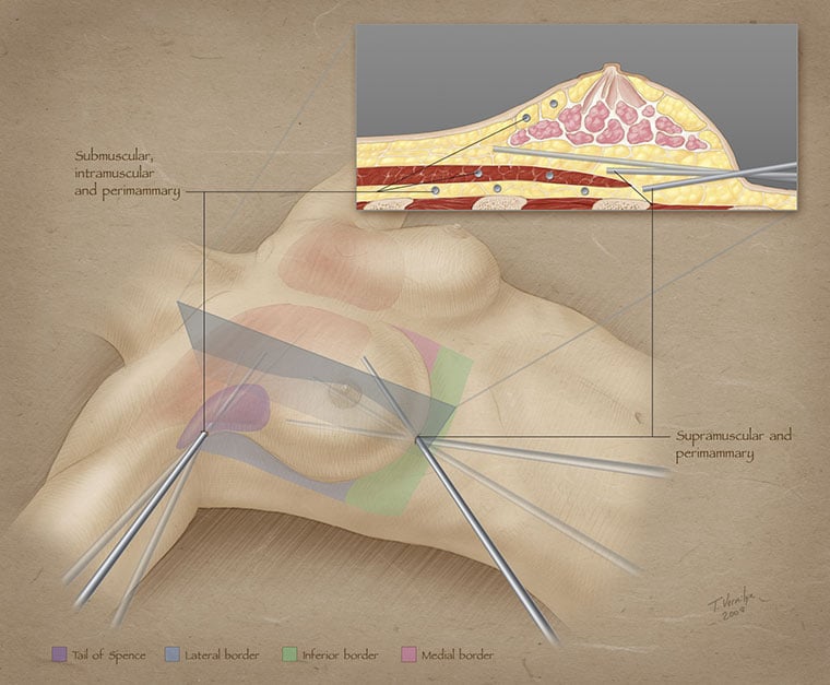 four different layers of fat grafting