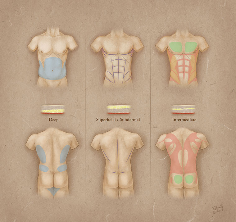 Male Body Contouring