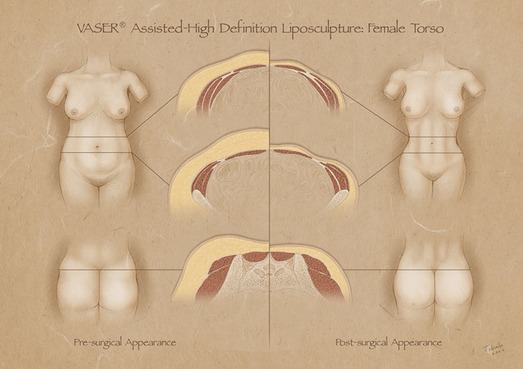 Vaser Liposuction Body Contouring, Hi Def Lipo