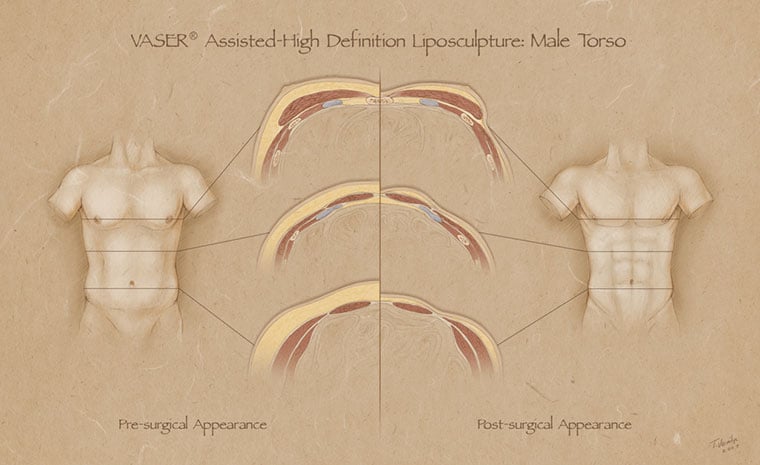 Revolutionizing Body Contouring: The Science Behind Vaser