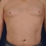 Gynecomastia Before & After Patient #2947