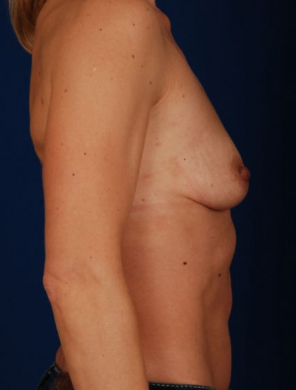 Breast Augmentation Before & After Patient #2973
