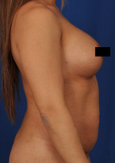 Tummy Tuck Before & After Patient #3072