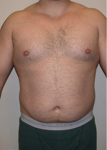 VASER Hi Def Liposuction Before & After Patient #2844