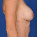 Breast Augmentation Before & After Patient #2973