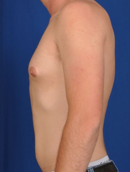 Gynecomastia Before & After Patient #2935