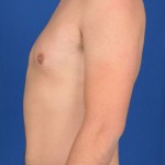 Gynecomastia Before & After Patient #2935