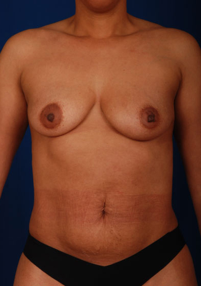 VASER Hi Def Liposuction Before & After Patient #3077