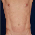 VASER Hi Def Liposuction Before & After Patient #2866