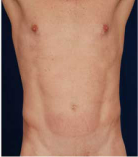 VASER Hi Def Liposuction Before & After Patient #2866