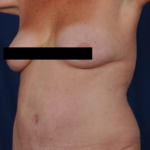 Tummy Tuck Before & After Patient #3080