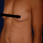 Tummy Tuck Before & After Patient #3084