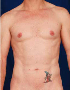 VASER Hi Def Liposuction Before & After Patient #2872