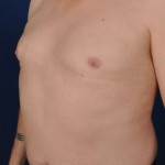 Gynecomastia Before & After Patient #2947