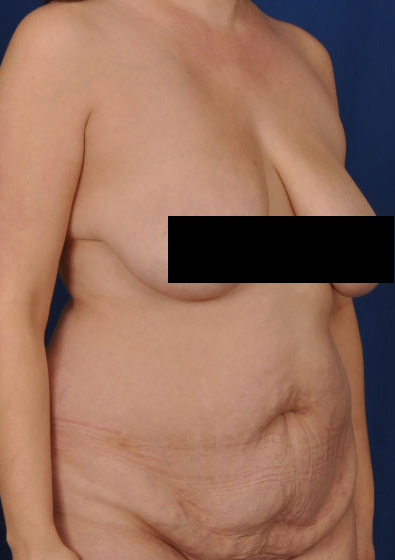 Tummy Tuck Before & After Patient #3087