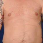 Gynecomastia Before & After Patient #2952