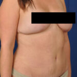 Tummy Tuck Before & After Patient #3087