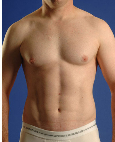 VASER Hi Def Liposuction Before & After Patient #2875