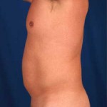 VASER Hi Def Liposuction Before & After Patient #2890