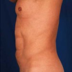 VASER Hi Def Liposuction Before & After Patient #2890