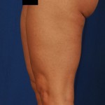 Legs Liposuction Before & After Patient #3097