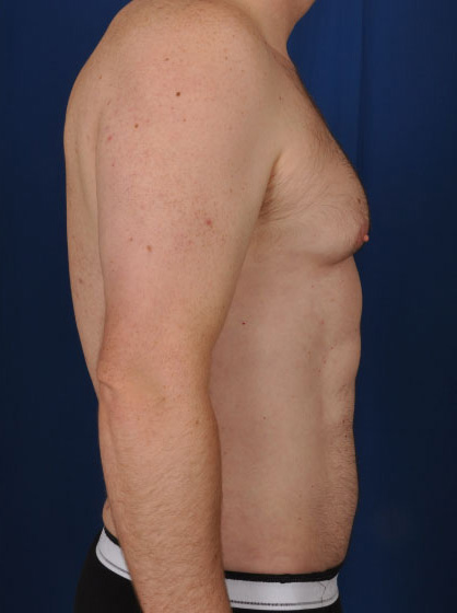 VASER Hi Def Liposuction Before & After Patient #2900