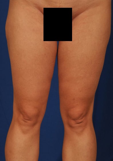 Legs Liposuction Before & After Patient #3097