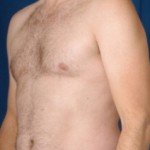 VASER Hi Def Liposuction Before & After Patient #2908