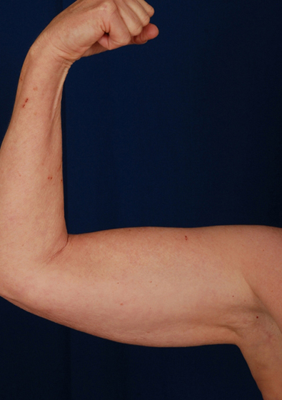 Arms Liposuction Before & After Patient #3108