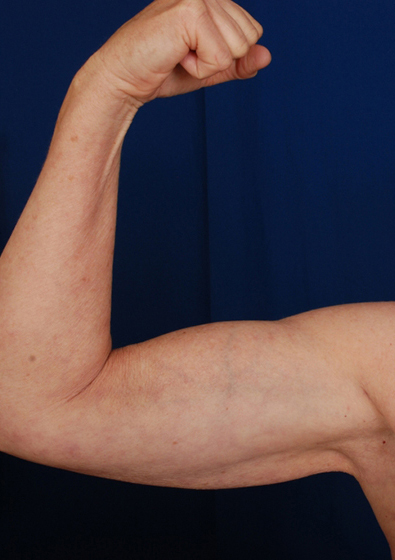 Arms Liposuction Before & After Patient #3108