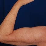 Arms Liposuction Before & After Patient #3113