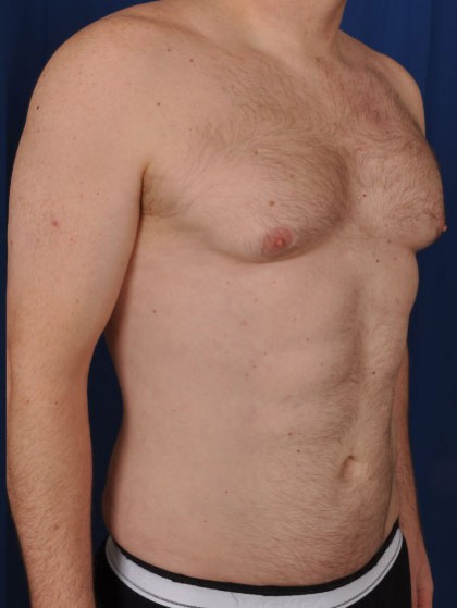 VASER Hi Def Liposuction Before & After Patient #2900