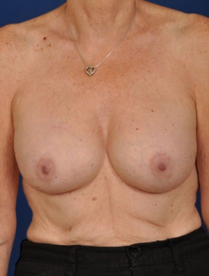Breast Augmentation Before & After Patient #3016