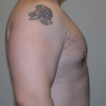 VASER Hi Def Liposuction Before & After Patient #2921