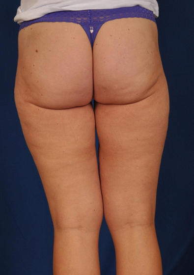 Legs Liposuction Before & After Patient #3118