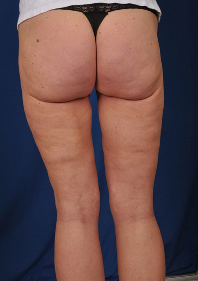 Legs Liposuction Before & After Patient #3118