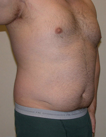 VASER Hi Def Liposuction Before & After Patient #2844