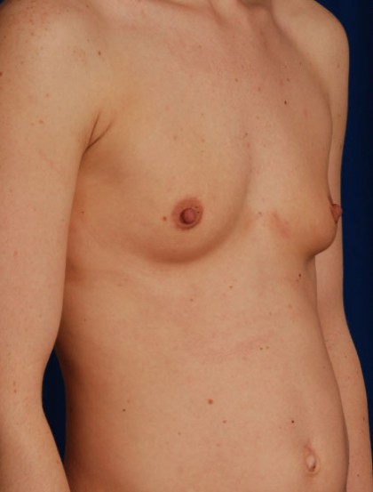 Breast Augmentation Before & After Patient #3039