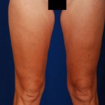 Legs Liposuction Before & After Patient #3129