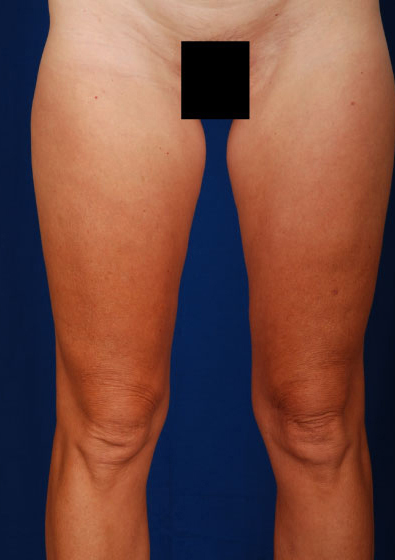 Legs Liposuction Before & After Patient #3129